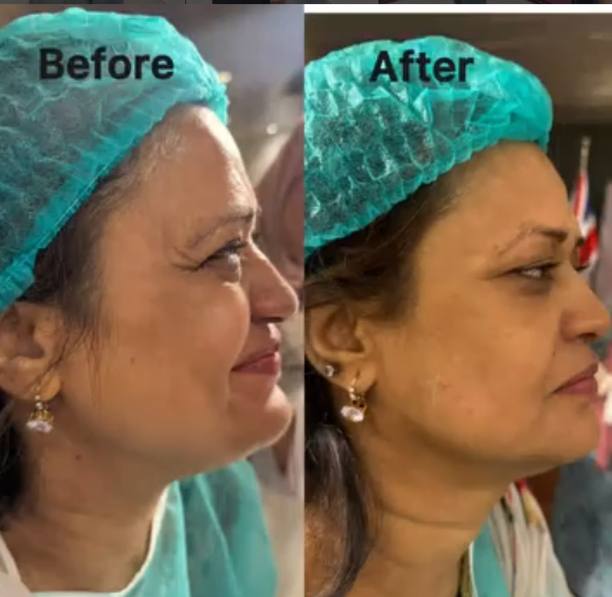 PRP Treatment Preview